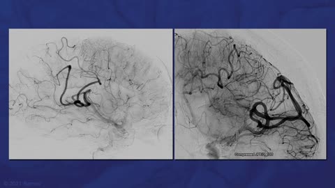 Microsurgical_Resection_of_a_Lateral_Parietal_Arteriovenous_