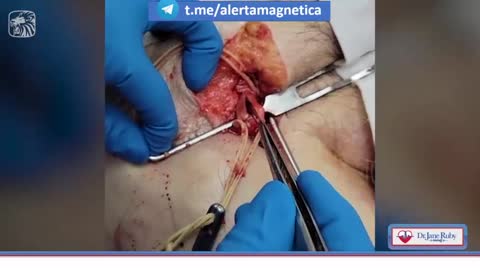 2022-02-03 Хирург извлекает из ног уколотых необычные кровяные сгустки