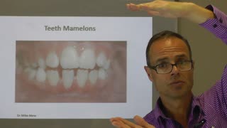 Teeth Mamelons By Dr Mike Mew