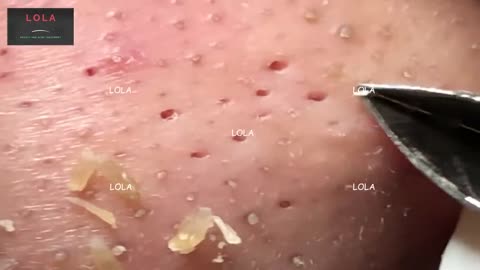 Most Relaxing, Satisfying, Enjoyable; Acne Removal