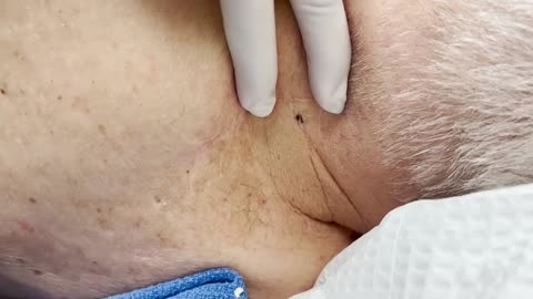 Quick Little Blackhead on the Neck