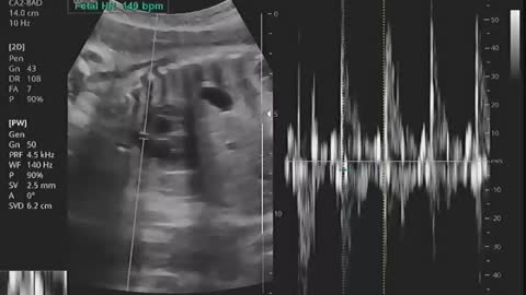 Baby ultrasound image and sound (6)
