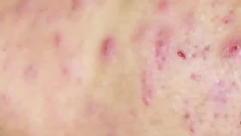 Blackhead removal on face video | Relax Every Day