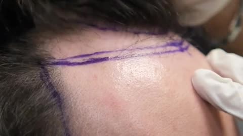 HAIR TRANSPLANT DAY OF A PATIENT