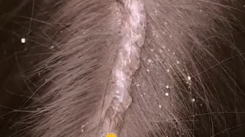Teach you how to get rid of dandruff and lose belly