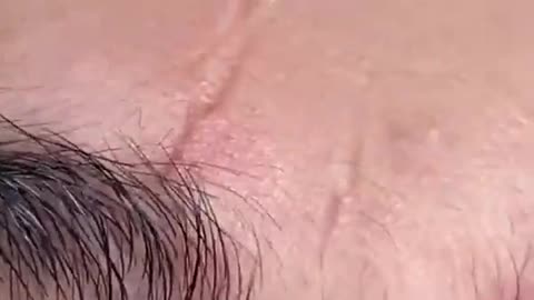 CYST EXPLOSION PIMPLE POPPING BLACKHEAD