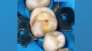 Removing large cavities from the middle of a tooth... Laborious
