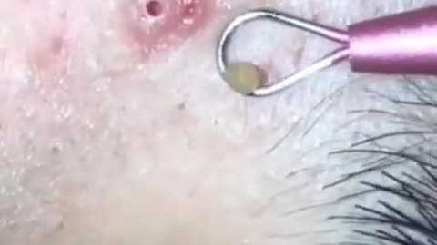 Pimple Popping Blackheads