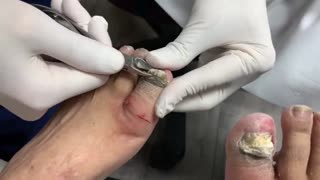 Extremely THICK and Sensitive NAIL CUTTING! **Patient Had To Be Numbed!!