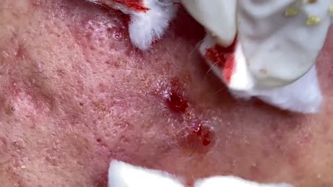 Pimple popping and blackhead removal