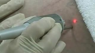 Laser Spider Vein Removal - Legs