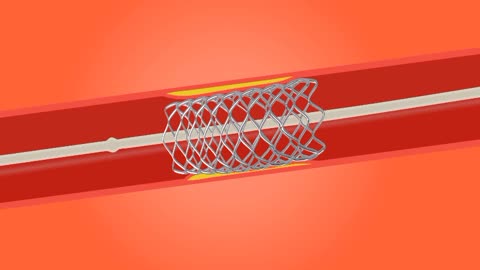 angioplasty and stent placement for treatment of heart disease, stroke and atherosclerosis