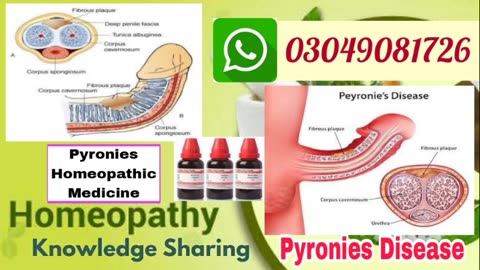 Peyronie's Disease | Curvature and plaque of penis | Homeopathic medicine for affection of penis