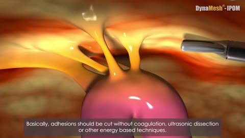 DynaMesh®-IPOM - Animation: Laparoscopic Repair of Incisional Hernia