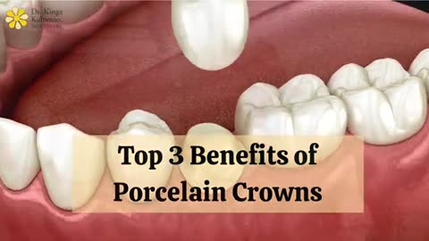 Top 3 Benefits of Porcelain Crowns