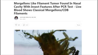 Morgellons Like Filament Tumor Found In Nasal Cavity After PCR Test