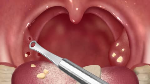 [ASMR] cause Of bad breath Tonsil stone removal animation