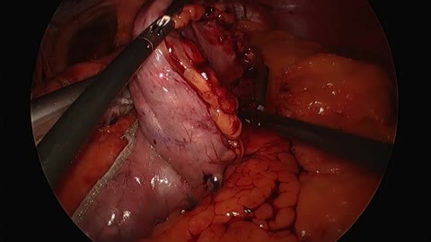 Sithsurgeon - Laparoscopic Vertical Sleeve Gastrectomy
