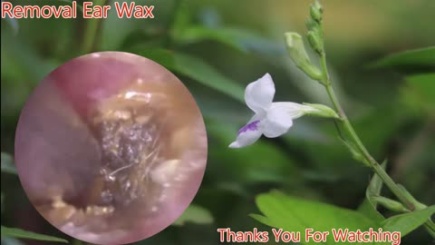 gigantic ear wax removal #17