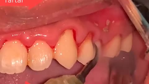 Tartar Dentist 2021 | Satisfying Dental-work