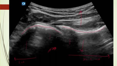 Ultrasound diagnose of shoulder dislocation