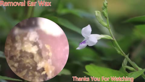 gigantic ear wax removal #4