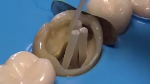 AMAZING dental caries treatment captured in 4k