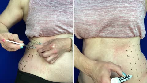 Aqualyx (Kybella)To Dissolve Fat in my Love Handles
