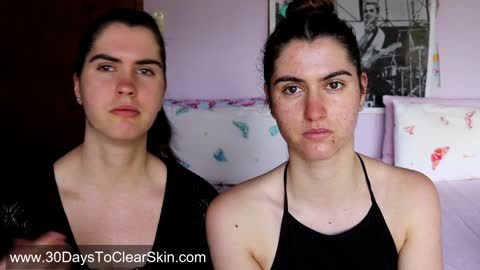 How my Twin Sister cured her Acne naturally (No Accutane)