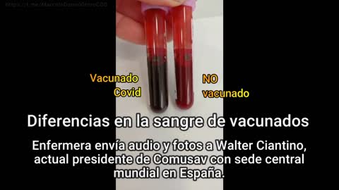 Spanish nurse exposes that the blood of those who have been jabbed is darker and has a high D-Dimer