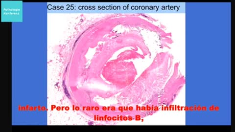 Prof. Dr. Arne Burkhardt y Prof. Dr. Walter Lang. Vacuna- miocarditis inducida