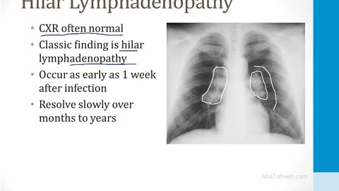 Pulmonary - 3. Other Pulmonary Topics - 6.Tuberculosis