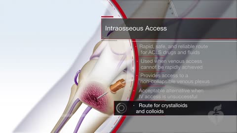 ACLS - 22 - Intraosseous (IO)