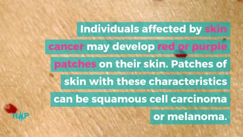 Key Indicators Of Skin Cancer