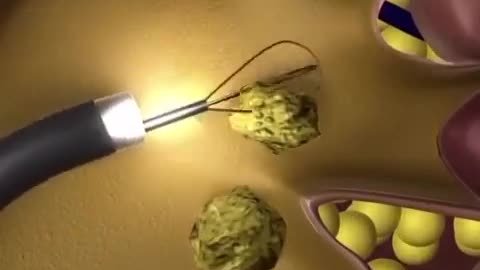 Kidney stone animation