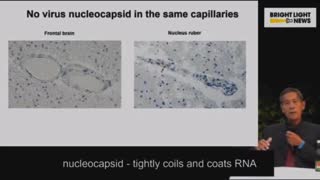 Dr.Sucharit Bhakdi about damage to the brain