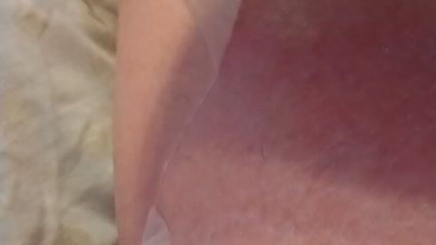 Skin peeling from sunburn part 1