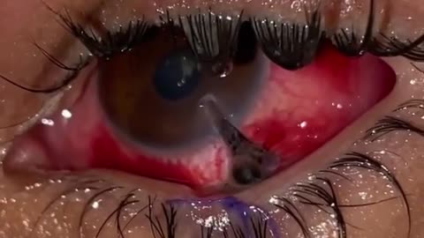 Ruptura globo ocular + herida en párpado inferior