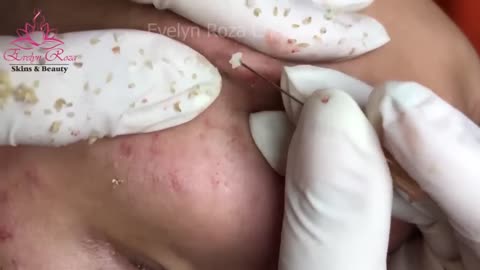 Big Blackheads Extracted