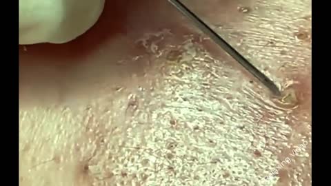 Satisfying Relaxing Acne Removal