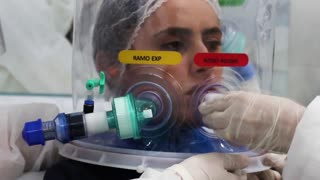 Un casco brasileño de respiración artificial reduce intubación en un 60 %