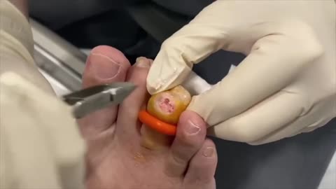 Cheesy Gout Removal