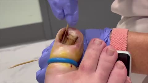 SQUIRTING 💦 INGROWN NAIL