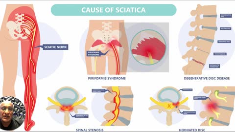 Causes Of Sciatica | Padda Institute Of Pain Management | St Louis