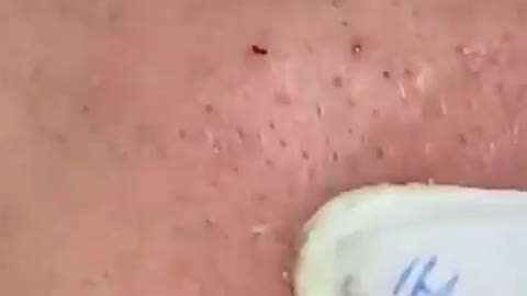 Giants Deep Blackheads, Whiteheads, Big Pimples, Hidden Acne Removal - Best Popping Videos #000018