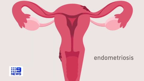 Endometriosis treatment 'breakthrough' made by NSW scientists