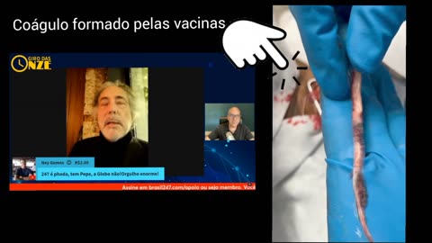 Conteúdo sensível : Um estranho coágulo fibroso branco é removido da veia jugular direita neste vídeo por causa do efeito colateral da picada COVID19.