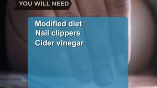 How to Cure Nail Fungus