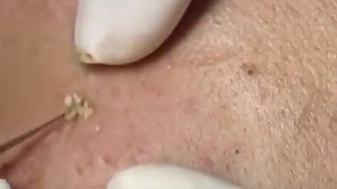 LARGE Blackheads Removal - Best Pimple