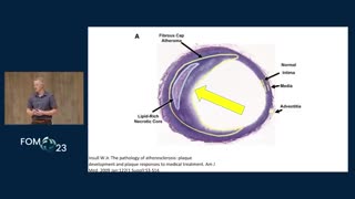 Dr Paul Mason The Cause of Atherosclerosis The Clotting and Seed Oil Toxicity